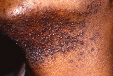 Pseudofolliculitis barbae use