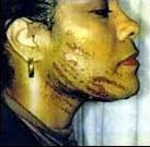 $100 million lawsuit (laser hair removal injury)